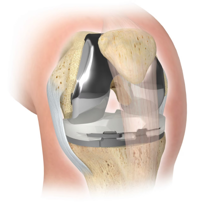 Dr. Marcelo Tostes Dr. Marcelo Tostes: Cirurgia - Prótese de joelho